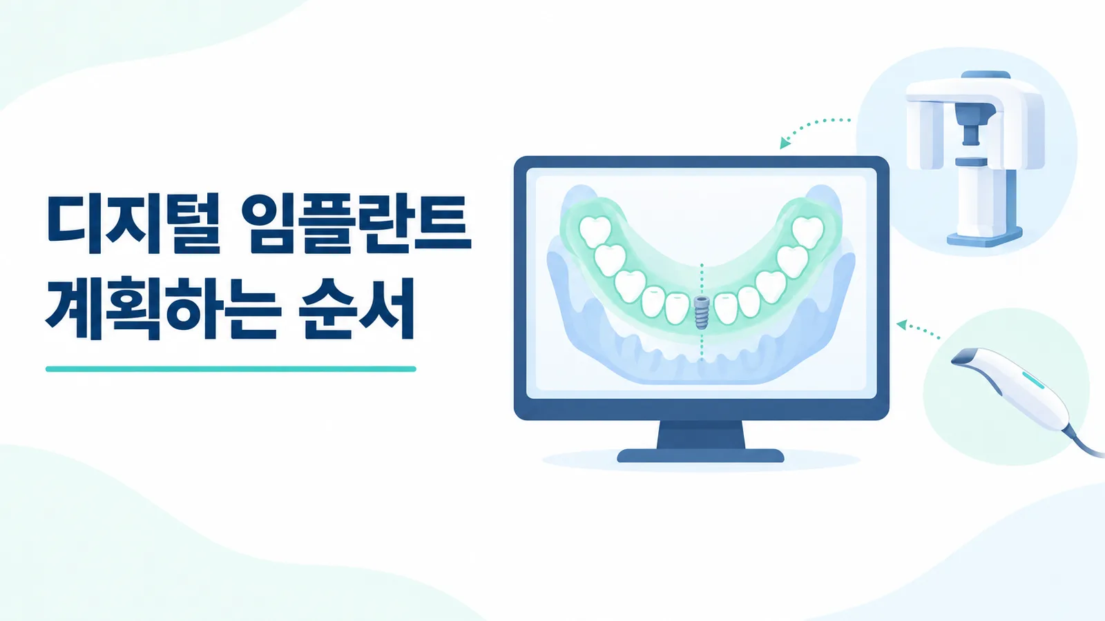 울산 삼산동 디지털 임플란트 - CT와 구강 스캔 자료를 모니터에서 겹쳐 임플란트 위치를 계획하는 도식